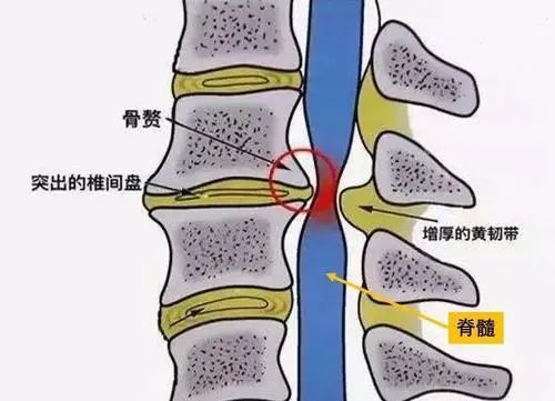 颈椎病怎么治疗最好的方法