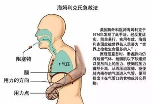 海姆立克的正确手法