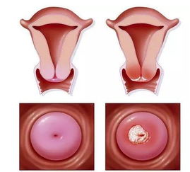 感染HPV就会得宫颈癌吗_感染了HPV就一定得宫颈癌吗？