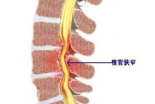 椎管狭窄的最佳治疗方法