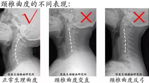 强直颈椎最快的恢复方法