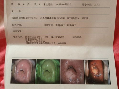 hpv16阳性算不算严重