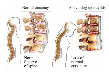 强直性脊柱炎背部疼痛