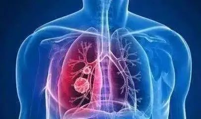 肺结节离肺癌还有非常远的距离_肺结节离肺癌有多远？很远…但发现肺结节也不要忽视！