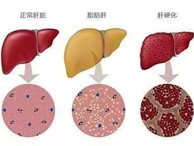 体检查出脂肪肝该咋办_体检查出脂肪肝，怎么办？3招教你甩掉脂肪肝