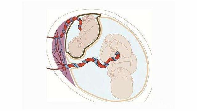 男婴腹中藏寄生胎是什么情况?寄生胎是什么寄生胎胎中胎揭秘