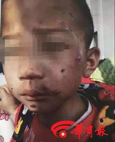 6岁男童遭虐待75%颅骨缺损成植物人 生父继母获刑 