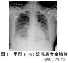 甲型流感的症状