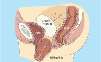 32岁二胎宝妈子宫脱垂掉到大腿上_32岁二胎宝妈子宫脱垂掉到大腿上