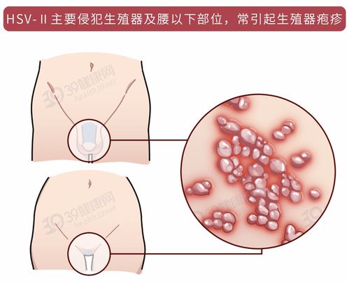 感染单纯疱疹病毒后会终身携带_一旦感染，终身携带！这种病毒冲上热搜，网友：经历过才懂